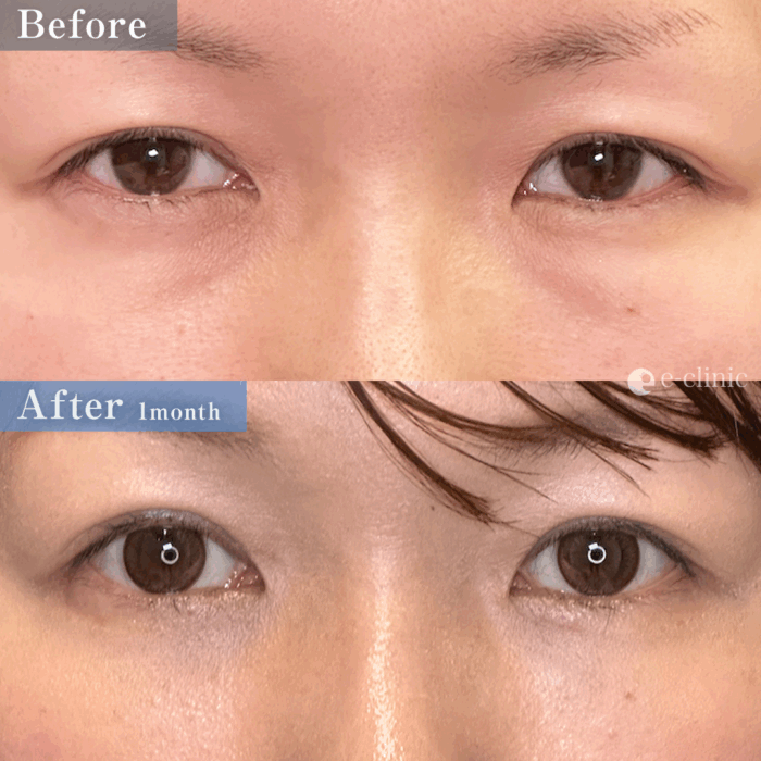 クマ取り_裏ハムラ（名医の坂本優衣医師が執刀）