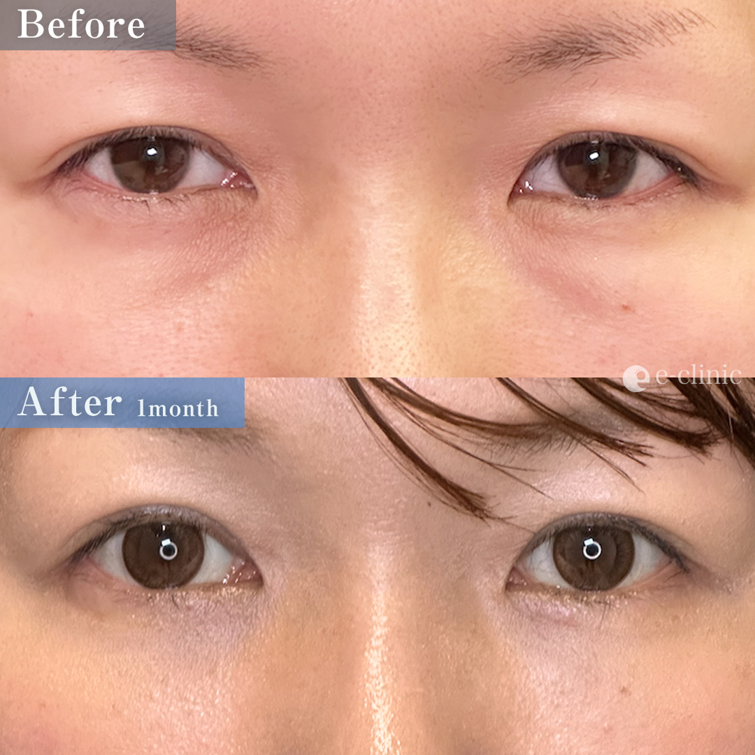 クマ取り_裏ハムラ（名医の坂本優衣医師が執刀）