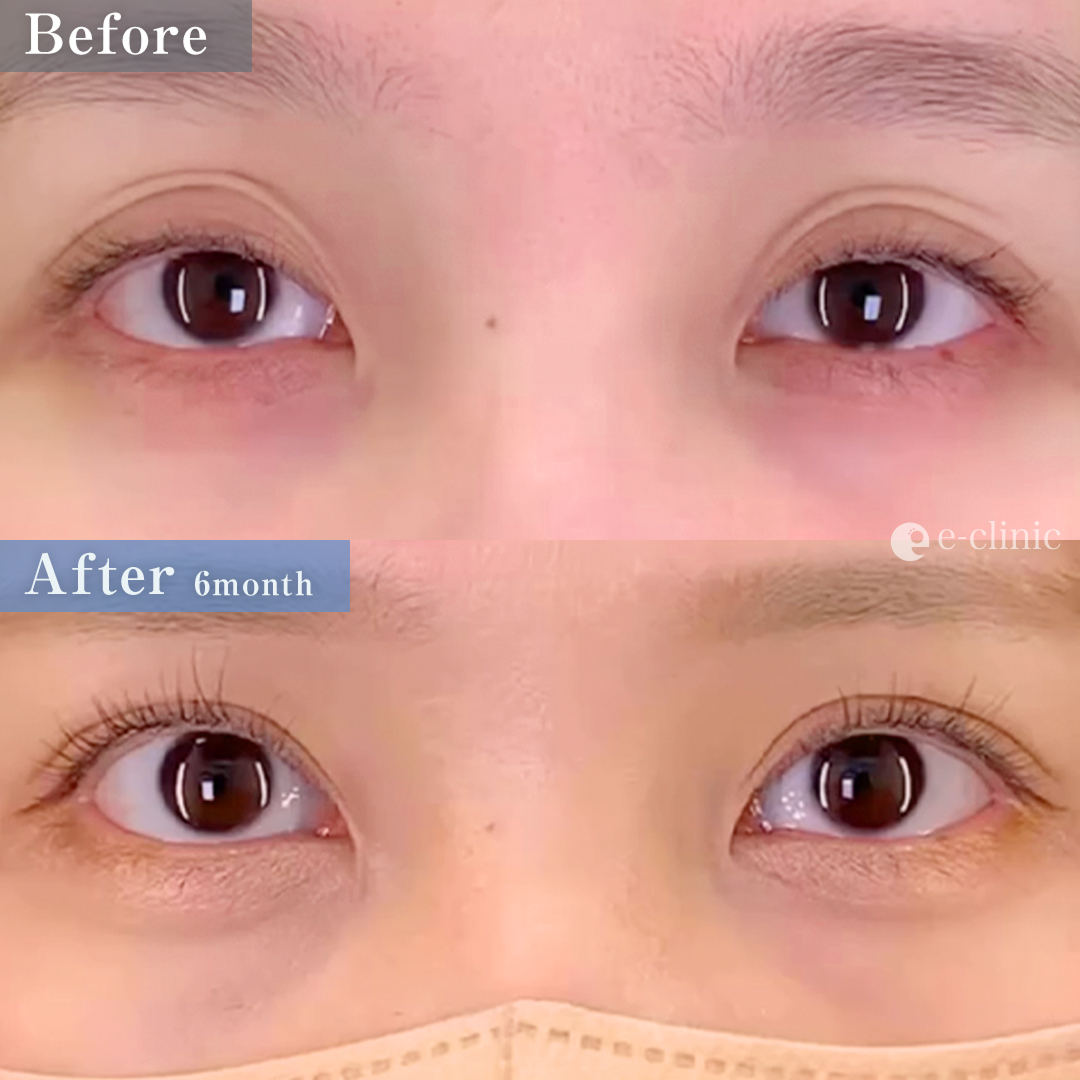 たるみ取り併用全切開二重術＋眼瞼下垂（名医の張田修平医師が執刀）