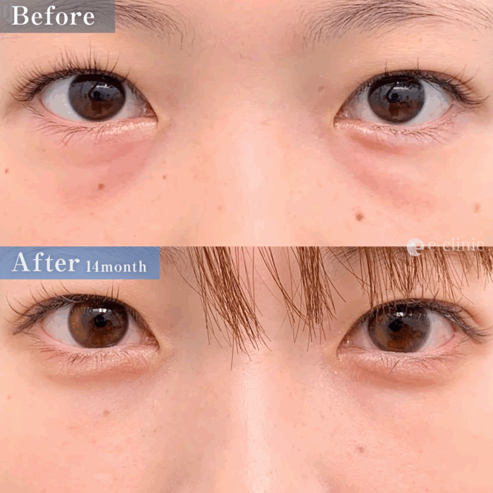 クマ取り_裏ハムラ法（名医の張田修平医師が執刀）