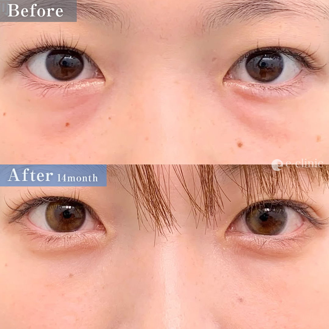 クマ取り_裏ハムラ法（名医の張田修平医師が執刀）