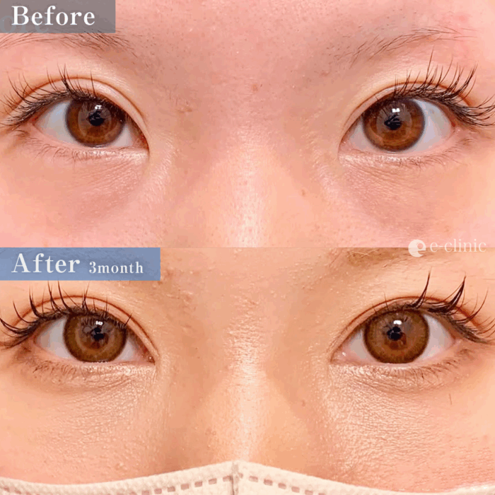 クマ取り_裏ハムラ法＋目頭切開（名医の張田修平医師が執刀）