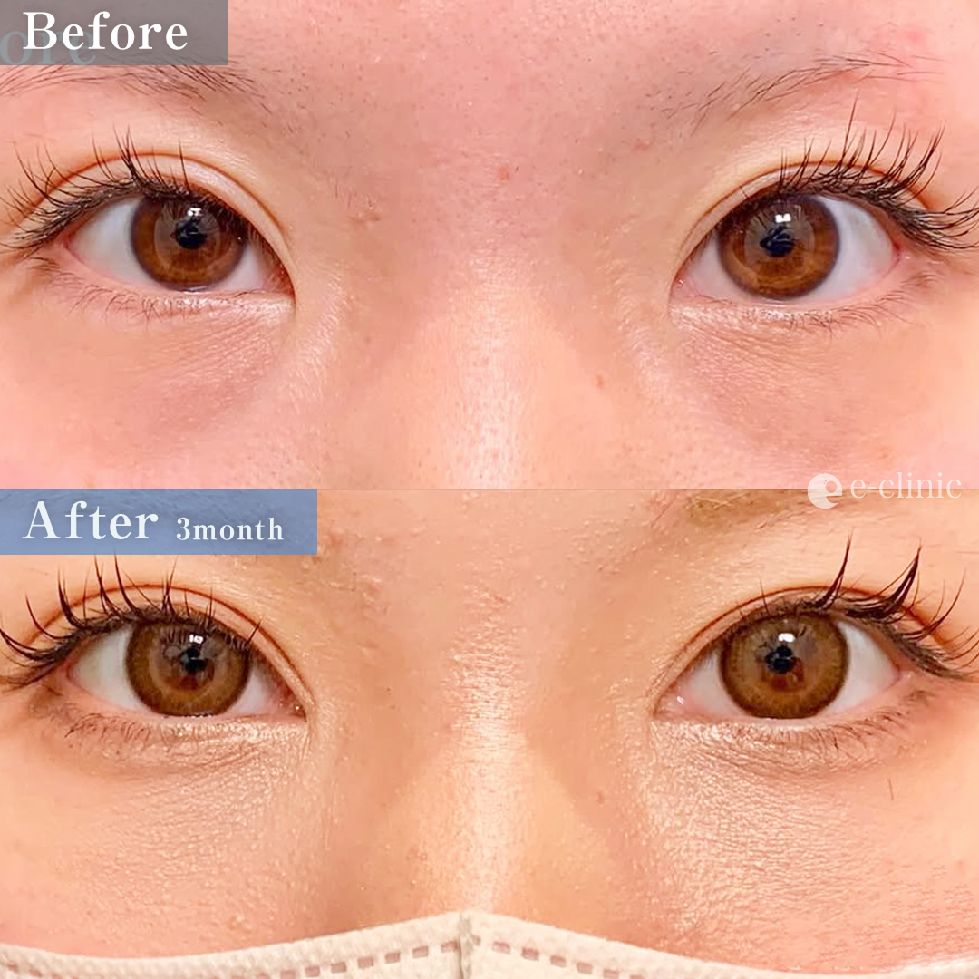 クマ取り_裏ハムラ法＋目頭切開（名医の張田修平医師が執刀）