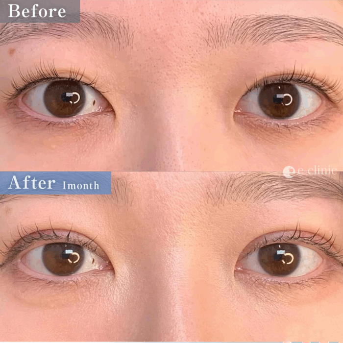 たるみ取り併用全切開二重術＋目の上脱脂（名医の張田修平医師が執刀）