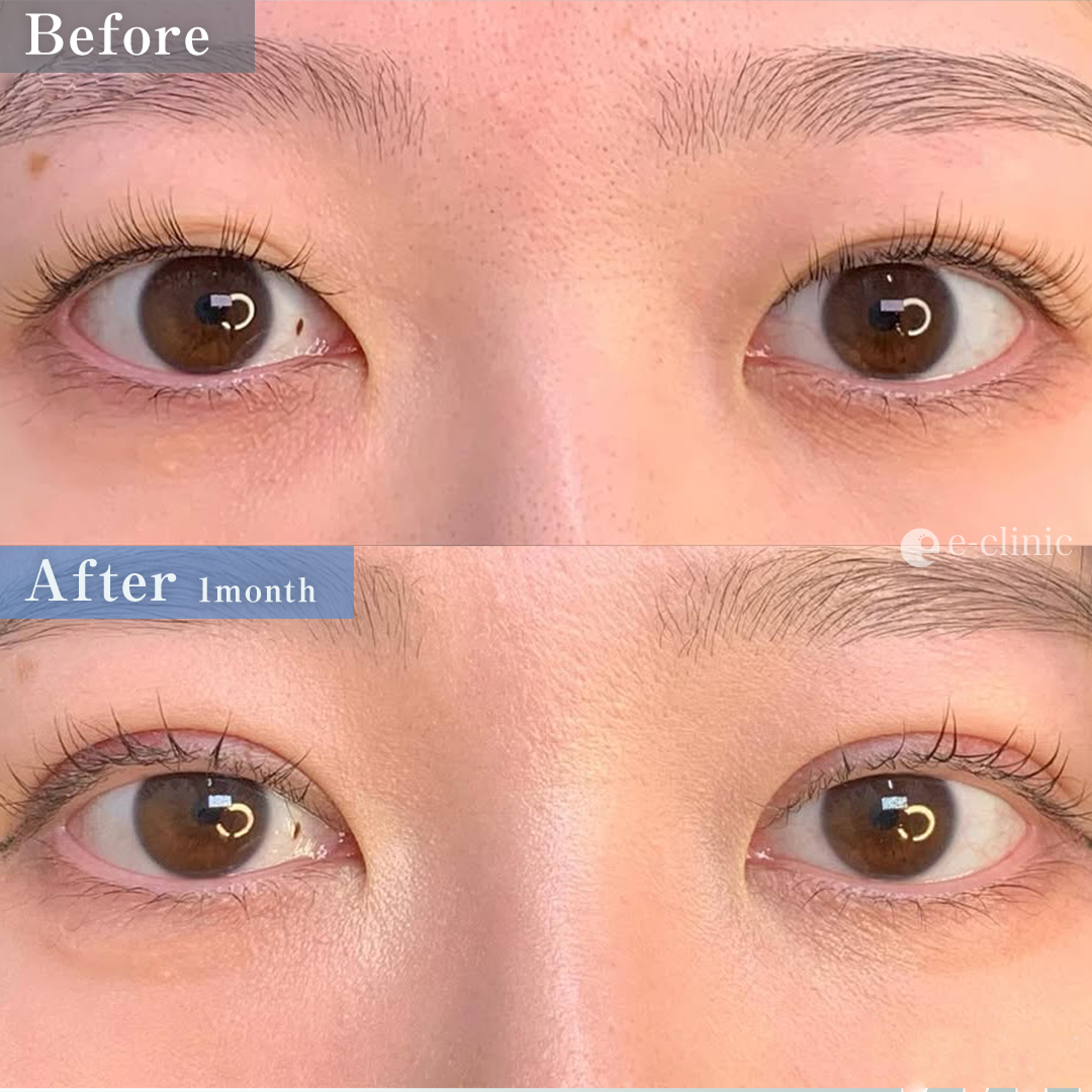 たるみ取り併用全切開二重術＋目の上脱脂（名医の張田修平医師が執刀）