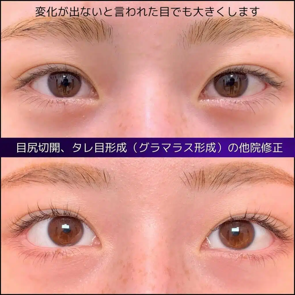 目尻 グラマラスライン形成