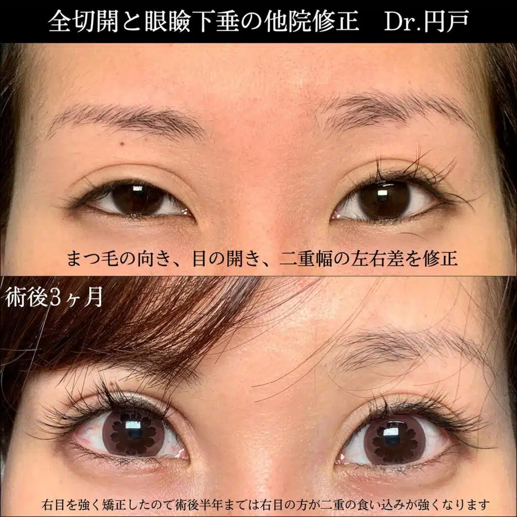 二重全切開 眼瞼下垂 他院修正