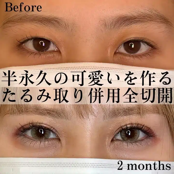 たるみ取り 全切開