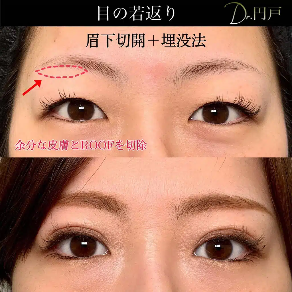 眉下切開 二重埋没法