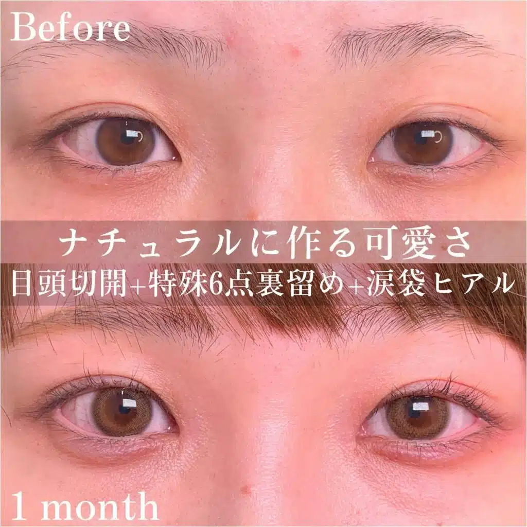 目頭切開 特殊6点裏留め 涙袋ヒアルロン酸