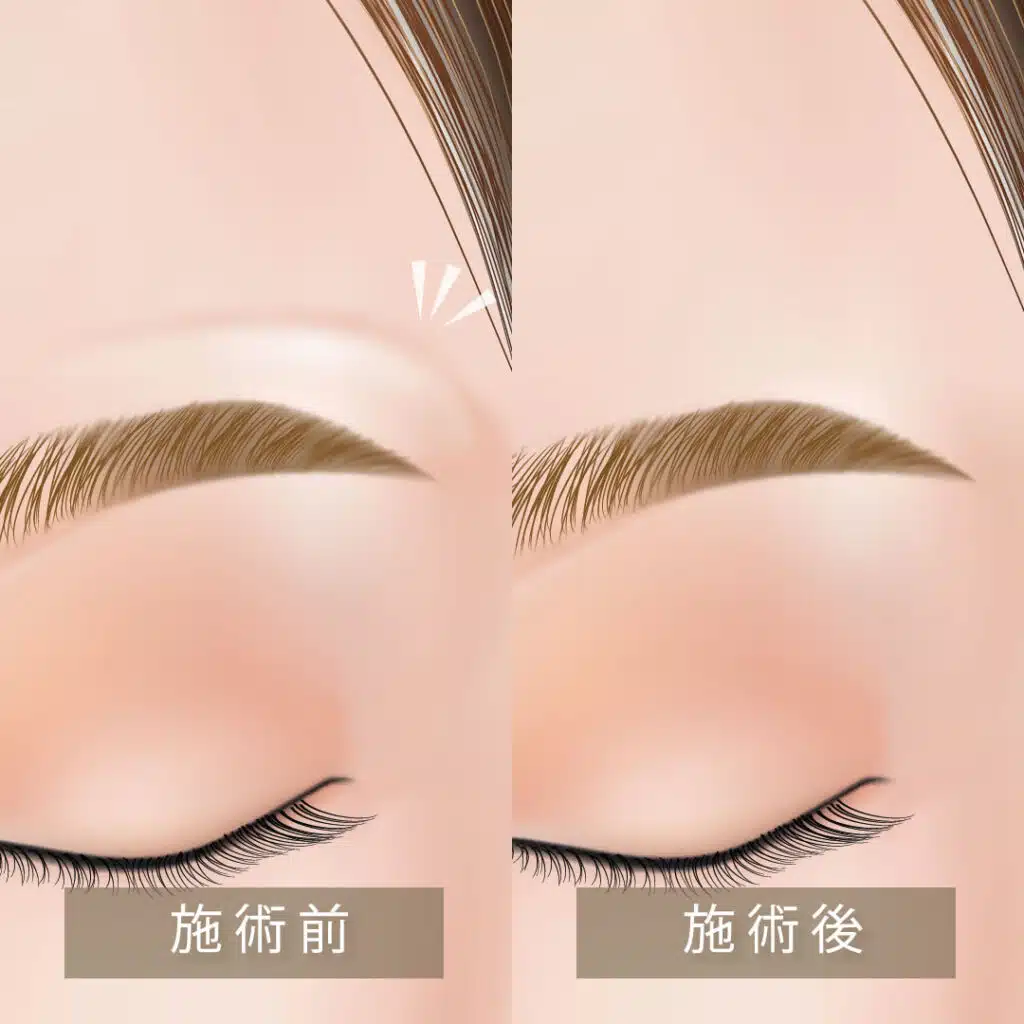 眉上ボトックス
