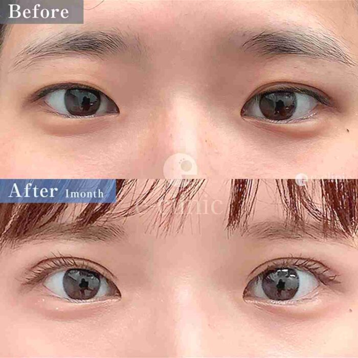 たるみ取り併用全切開二重術＋軽度眼瞼下垂（名医の飯田秀夫医師が執刀）