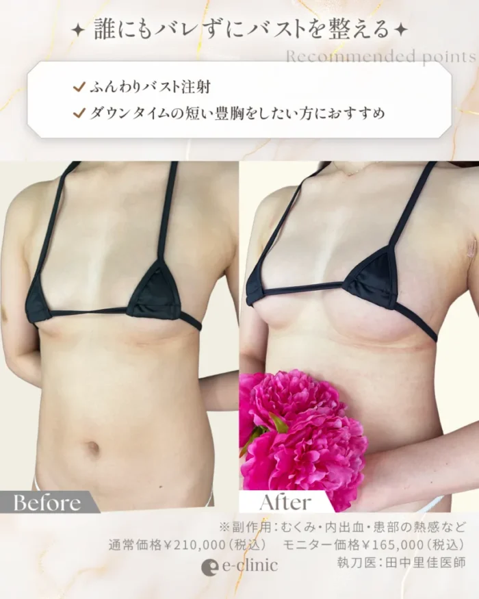 ふんわりバストの症例2