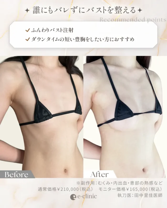 ふんわりバストの症例写真