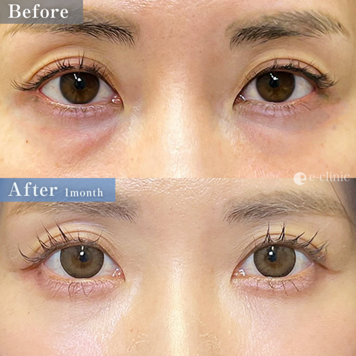 クマ取り_経血膜脱脂＋脂肪注入（名医の劉奕陽医師が執刀）