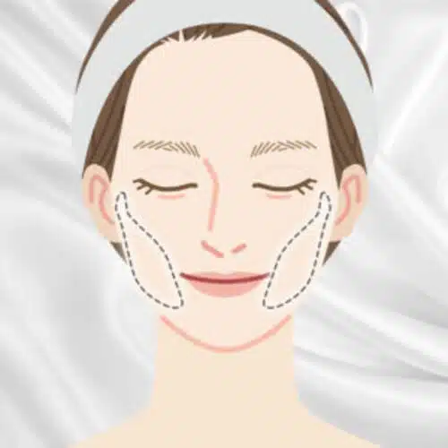 バッカルファット除去_図解