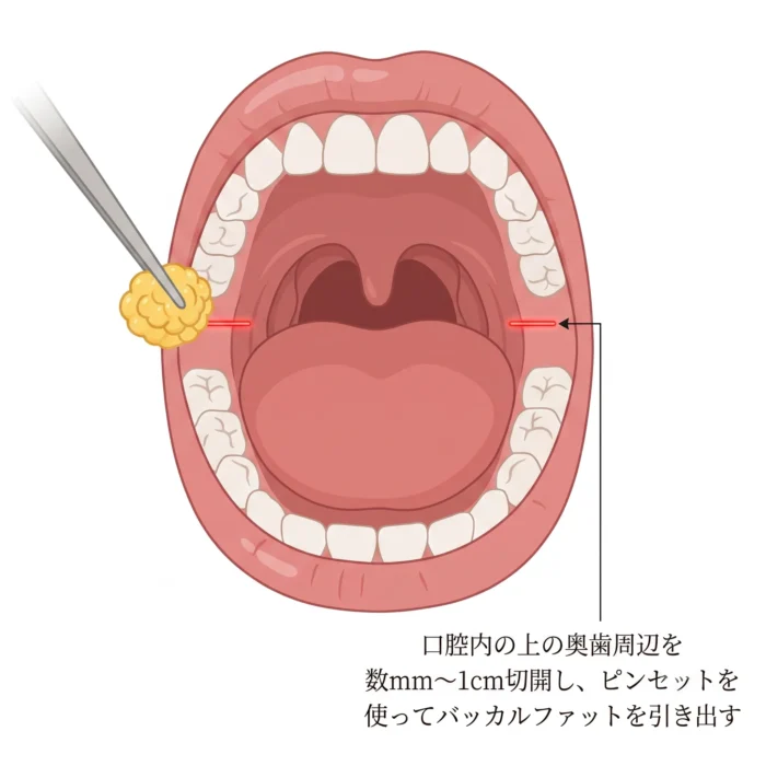 バッカルファット除去（口腔内から切除）図解