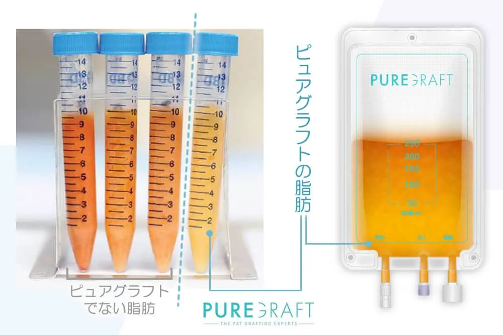 ピュアグラフトで抽出した脂肪