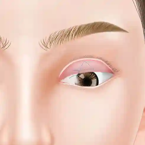 眼瞼下垂_ミュラー筋タッキング法の図解