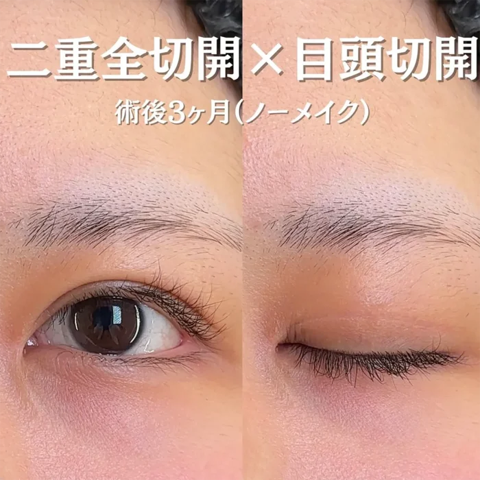 二重全切開法＋目頭切開の傷跡