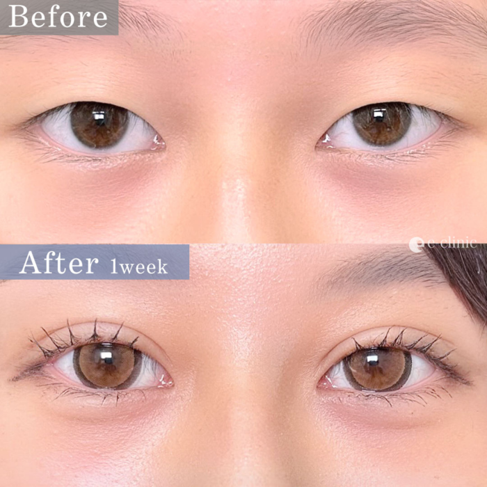 二重埋没法_自然癒着法（名医の相原隆充医師が執刀）