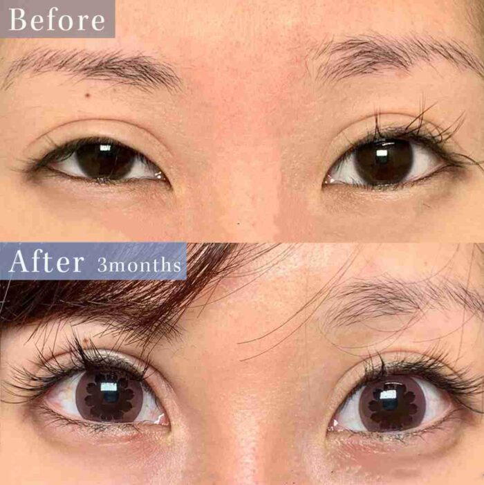 全切開二重術修正＋眼瞼下垂の他院修正＋他院修正料金（名医の円戸望医師が執刀）（103）