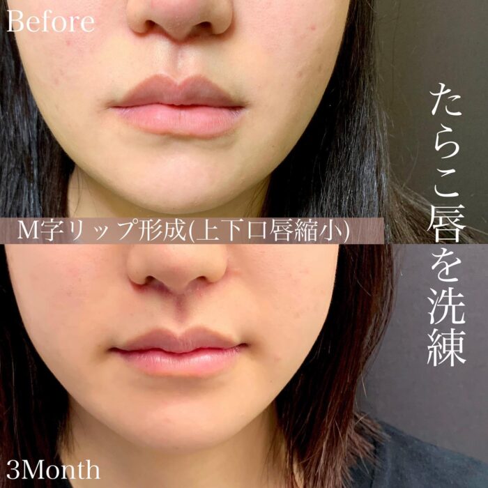 口唇縮小の症例写真