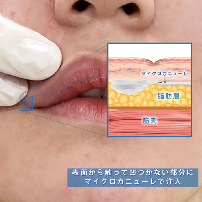 唇にヒ唇にヒアルロン酸を注入している所アルロン酸を注入している所