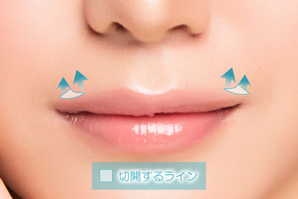 外側人中短縮術のイメージ