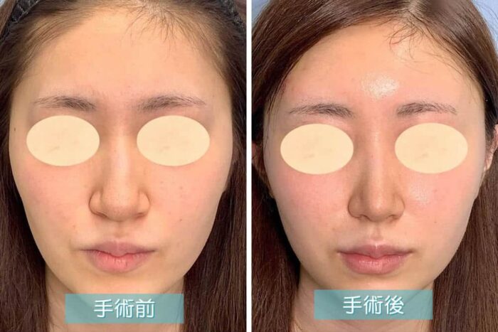 小鼻縮小の症例画像
