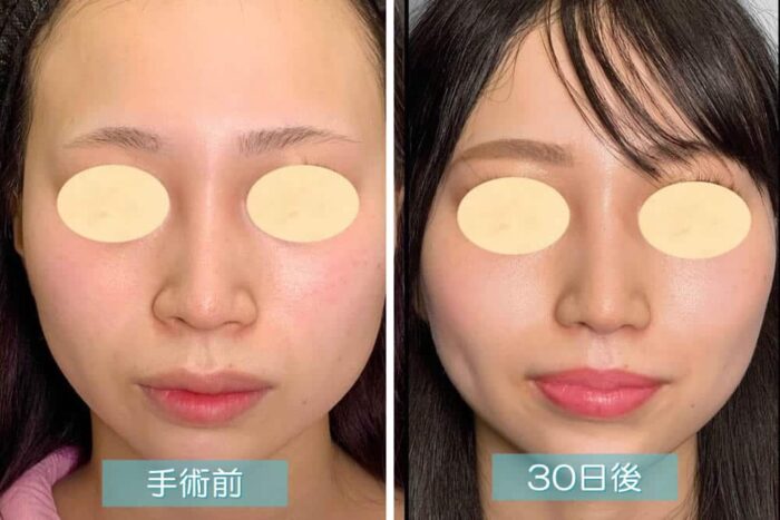 小鼻縮小の症例画像