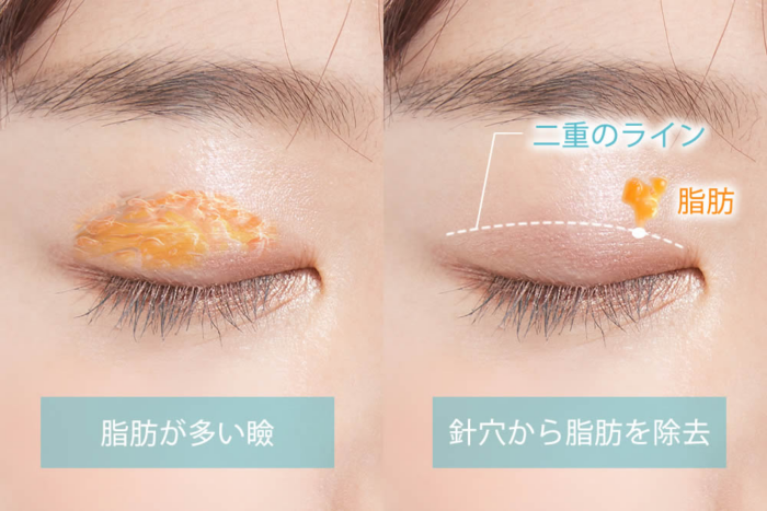 eクリニックの上まぶたのたるみ取りの図解