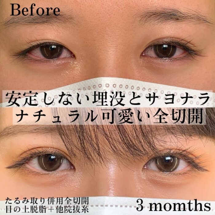 たるみ取り併用全切開二重＊＋目の上脱脂の症例写真（名医の張田修平医師が執刀）