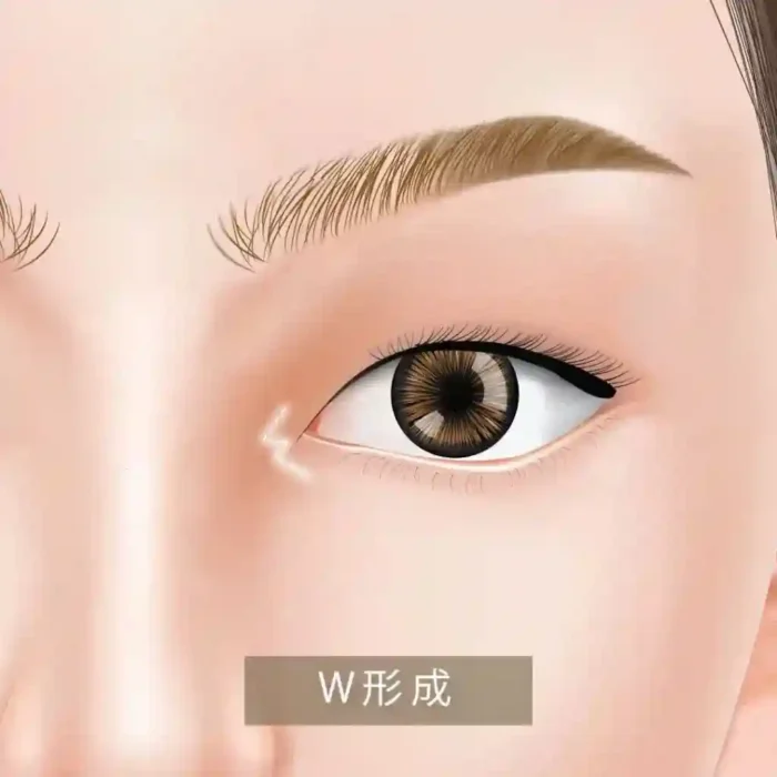 目頭切開_W型の図解