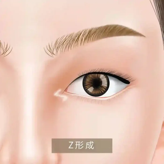 目頭切開_Z型の図解