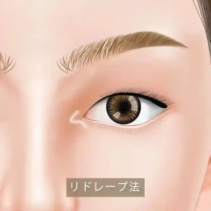 目頭切開_リドレープ法の図解