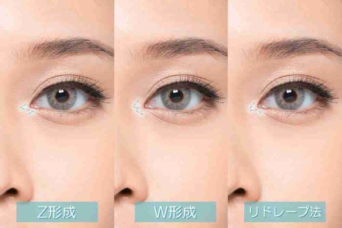 eクリニックの目頭切開（Z形成、w形成、リドレープ法）の図解