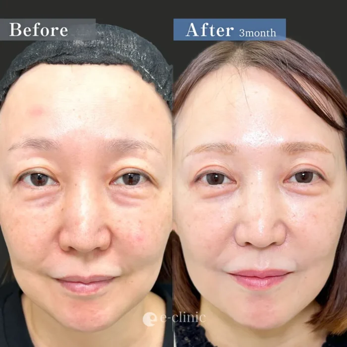 眉下切開＋クマ取り_裏ハムラ法（名医の伊藤渉医師が執刀）