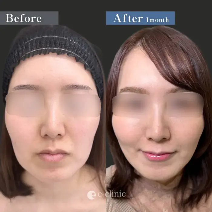 糸リフト（名医の伊藤医師が執刀）