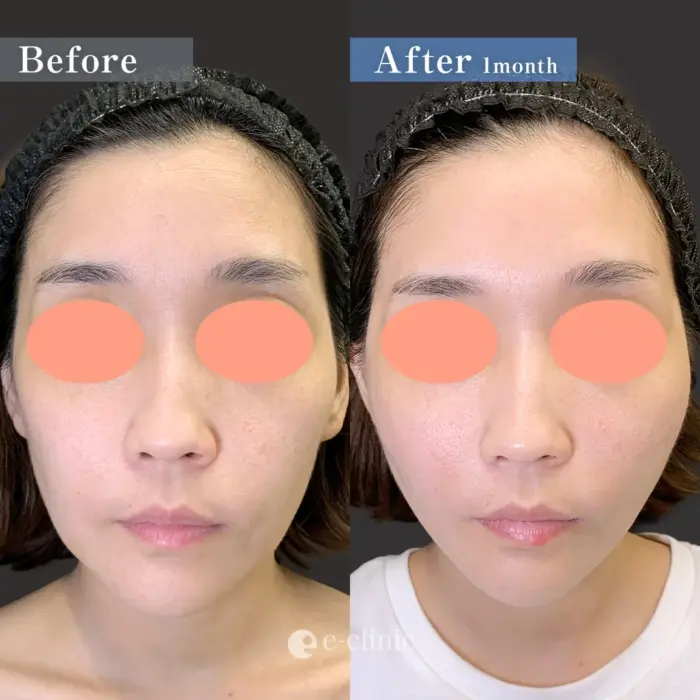 糸リフト（名医の田中医師が執刀）