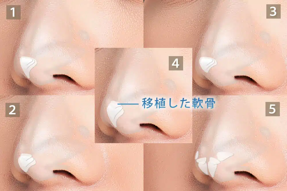 鼻の耳介軟骨移植イメージ