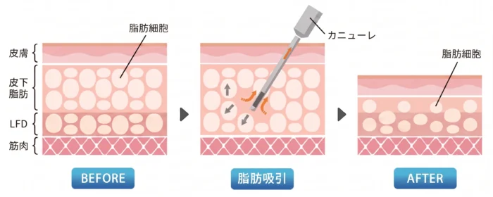 脂肪吸引の図解1
