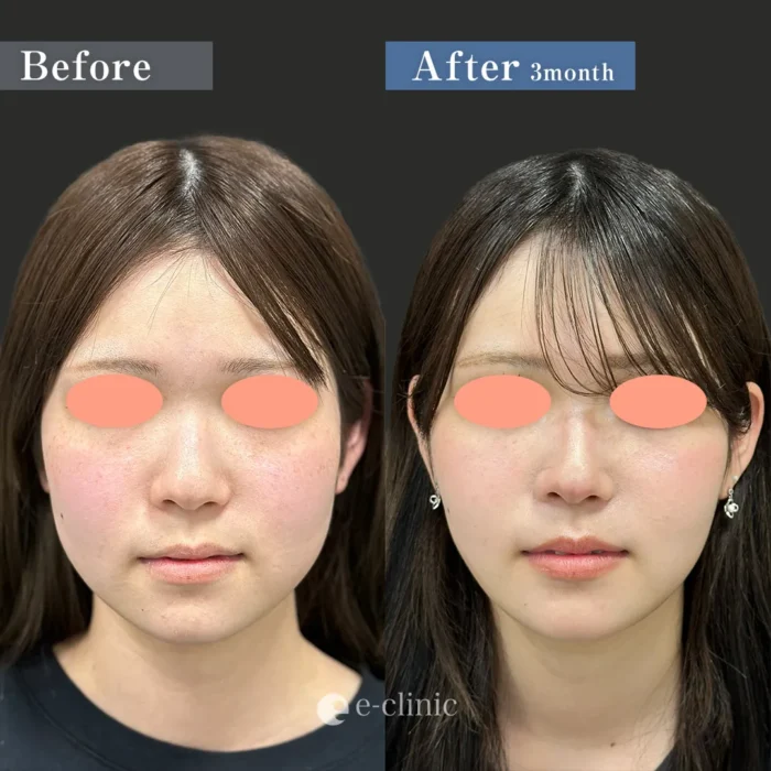 eクリニックの顔の脂肪吸引の症例写真_脂肪吸引（頬）＋糸リフト＋ボトックス（エラ）（服部健人）（60）