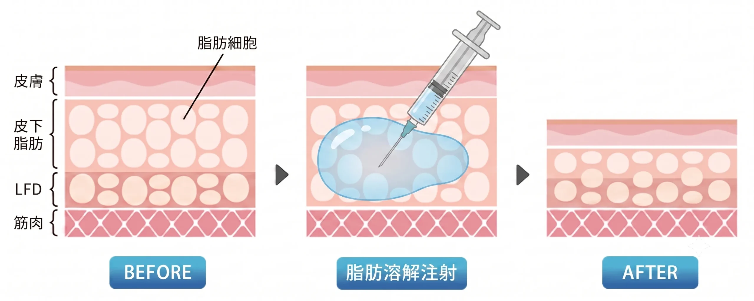 脂肪溶解注射の図解