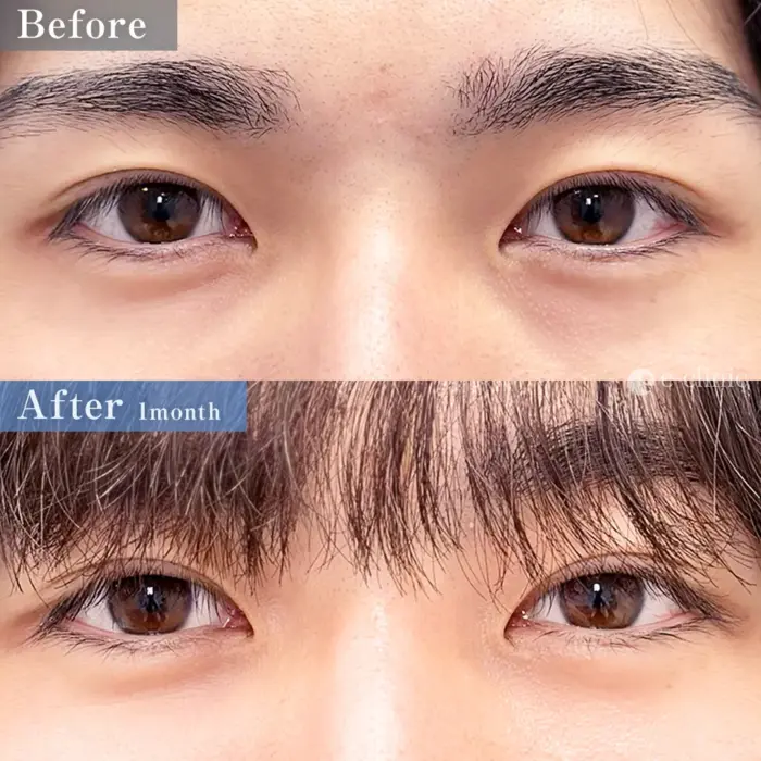 裏ハムラ法＋内固定オプション（名医の服部医師が執刀）