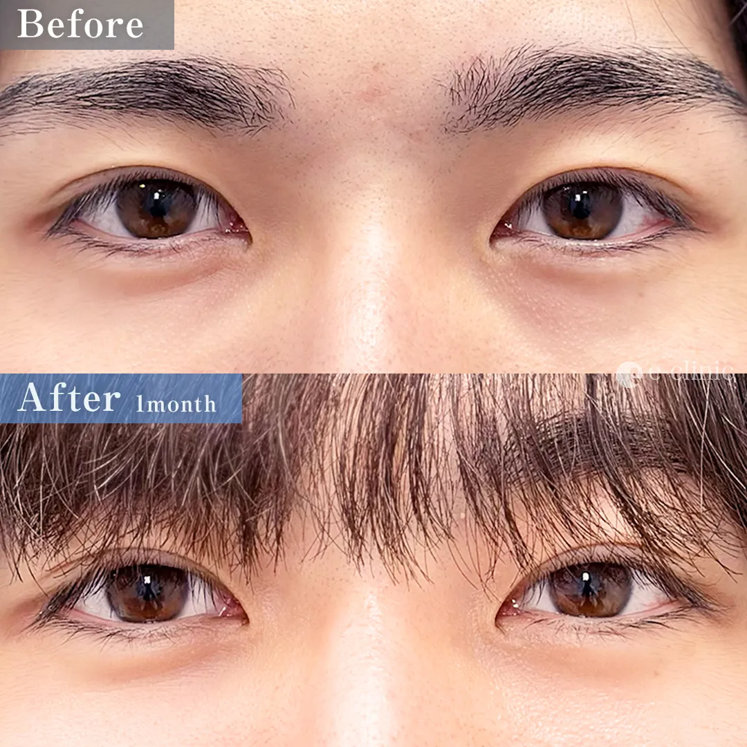 裏ハムラ法＋内固定オプション（名医の服部医師が執刀）