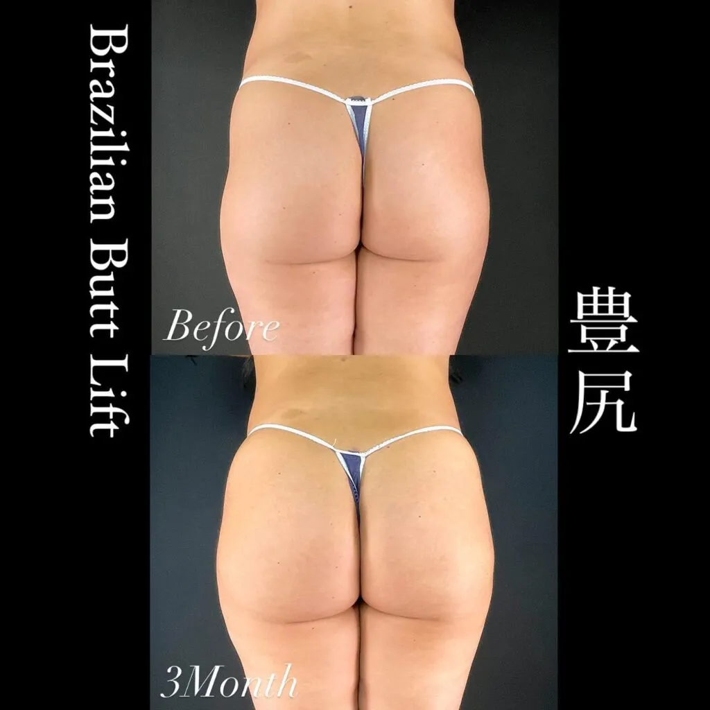 豊尻の症例写真