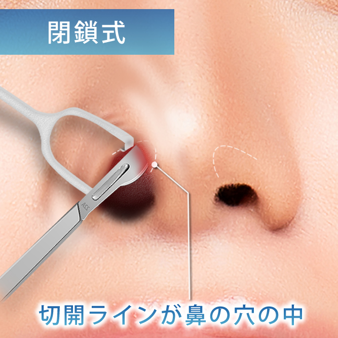 閉鎖式 鼻中隔延長の切開ラインの分かり易い図解