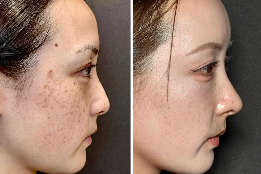 閉鎖式鼻中隔延長の症例写真