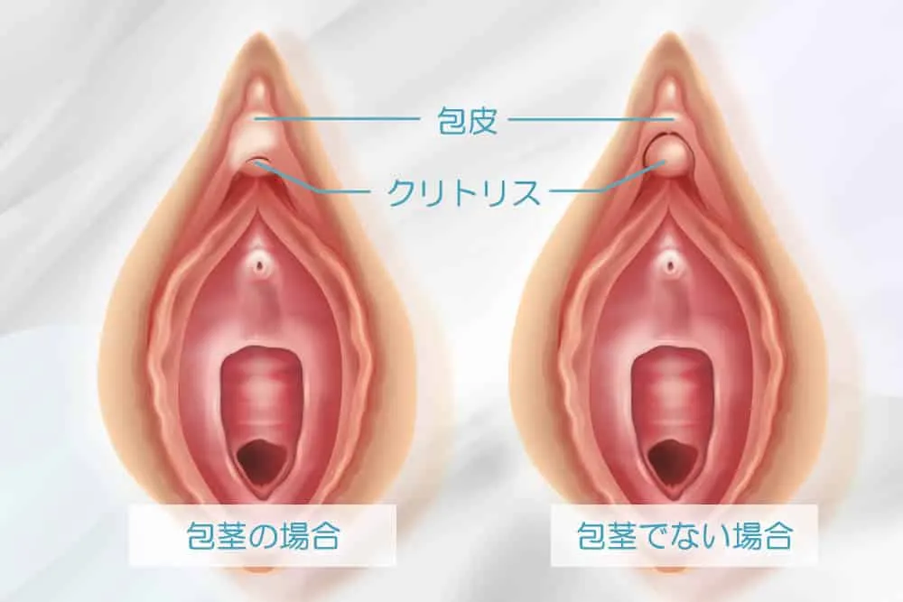 陰核包茎の図解